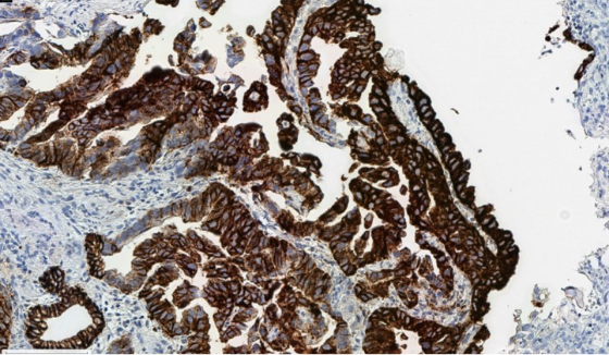 固定条件が不適切であったため、細胞質が染まり、膜染色性の評価に影響を及ぼしている例