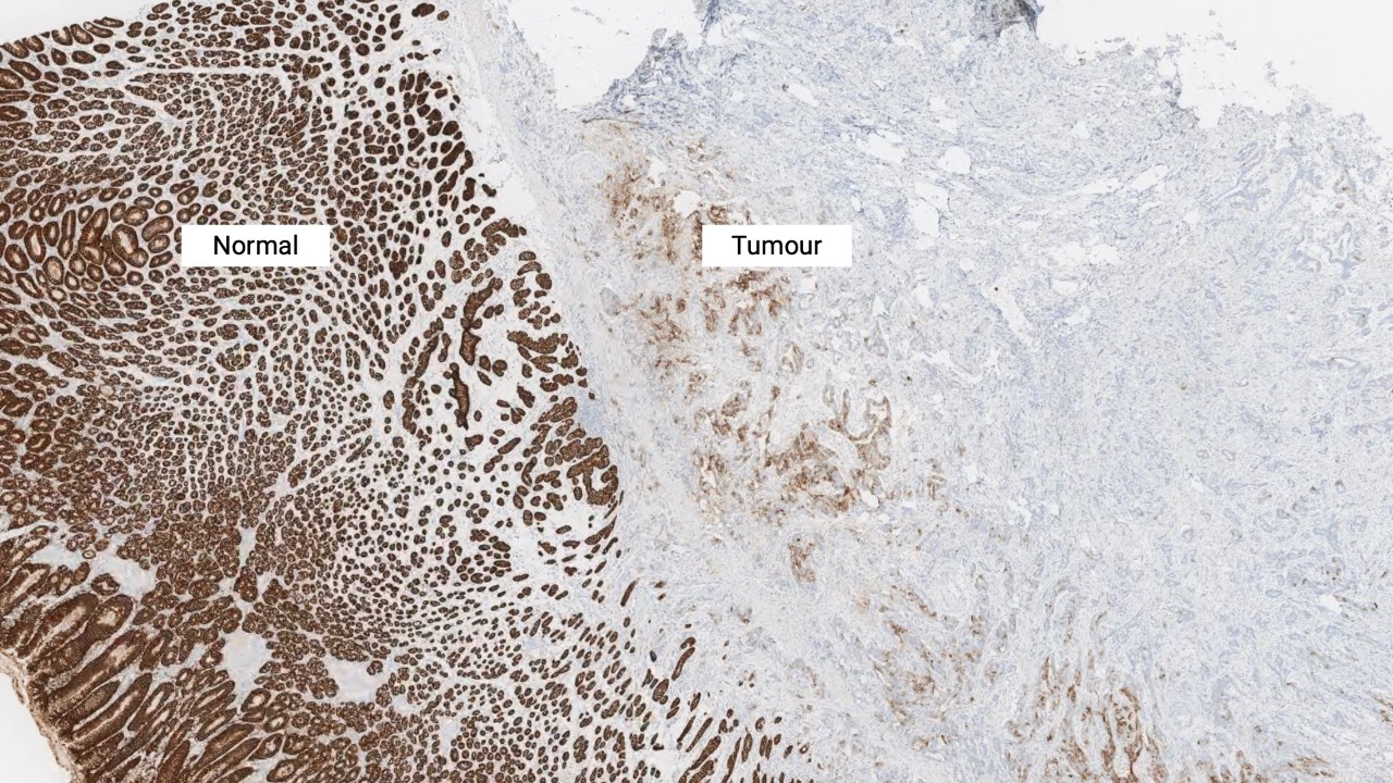 CLDN18 で染色した正常胃上皮細胞と腫瘍細胞の 2 倍の拡大図。