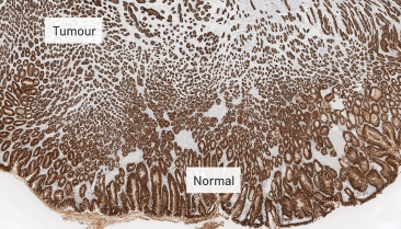 正常細胞および癌細胞におけるCLDN18染色像（5倍）